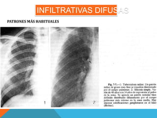 INFILTRATIVAS DIFUSAS 
PATRONES MÁS HABITUALES 
 