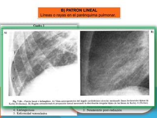 B) PATRON LINEAL 
Líneas o rayas en el parénquima pulmonar. 
a) Patrón lineal o linfangitico: 
• Líneas de Kerley. 
• Engrosamiento de los septos 
interlobulillares. 
• Líneas de Kerley A producen 
patrón reticular en el tórax. 
• Líneas de Kerley B 
horizontales 1-2cm longitud 
situados en los senos 
costodiafragmaticos, desde la 
superficie pleural se dirigen al 
interior del pulmón. 
b) Densidades pequeñas irregulares: 
• Forma irregular, tamaño mas 
grueso que líneas de Kerley, no 
siguen los trayectos septales, 
aspecto mas grosero. 
 