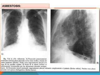 ASBESTOSIS: 
Exposición al asbesto. 
Inhalación de fibras de asbesto 100μ de 
largo. 
Minería de Asbesto y posterior proceso, 
construcción de buques, textiles. 
Individuos que manejan ropa 
trabajadores del asbesto, viven cerca de 
una mina. 
HALLAZGOS RADIOLOGICOS 
DE 4TIPOS: 
1. Formación de Placas 
2. Engrosamiento pleural difuso 
3. Calcificación 
4. Derrame pleural. 
 