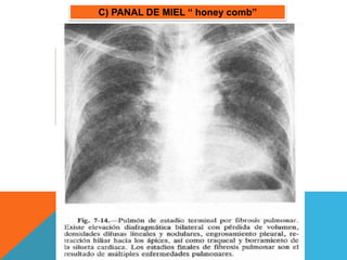 C) PANAL DE MIEL “ honey comb” 
• Parénquima Pulmonar de quistes pequeños 1cm 
diámetro. 
• Uniformes, redondeados o ovalados. 
• Panalizacion signo radiológico fiable de Fibrosis 
Intersticial. 
• Pulmón en “estadio final”. 
 