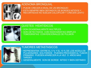 ADENOMA BRONQUIAL 
• PUEDE CRECER A NIVAL DE UN BRONQUIO 
• ESTA SIEMPRE BIEN DEFINIDOS DE BORDES NITIDOS Y 
RECORTADOS NO SUELEN CALCIFICAR Y CRECEN LENTO 
QUISTES HIDATIDICOS 
• SON OCASIONALMENTE MULTIPLES 
• SON DETECTADOS CON RADIOGRAFIAS SIMPLES 
TOMOGRAFIAS CONVENCIONALES DE PULMON 
TUMORES METASTASICOS 
• REPRESENTAN ENTRE EL 5 % Y EL 10 % DE LOS NODULOS 
PULMONARES SOLITARIOS PUEDEN PROCEDER AL TUMOR 
PRIMARIO PUEDEN APARECER A LA VEZ O AÑOS MAS 
TARDES 
• GENERALMENTE SON DE BORDE NITIDO Y BIEN DEFINIDO 
 