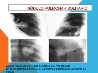 NÓDULO PULMONAR SOLITARIO 
Nódulo redondeado. 2Nódulo de bordes muy mal definidos 
un adenocarcinoma primitivo. 3: Carcinoma epidermoide4: Carcinoma de 
células 
 