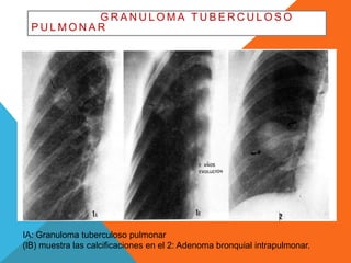 GRANULOMA TUB ERCULOSO 
PULMONAR 
IA: Granuloma tuberculoso pulmonar 
(lB) muestra las calcificaciones en el 2: Adenoma bronquial intrapulmonar. 
 