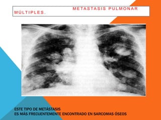 M E TA S TA S I S P U L M O N A R 
M Ú LT I P L E S . 
ESTE TIPO DE METÁSTASIS 
ES MÁS FRECUENTEMENTE ENCONTRADO EN SARCOMAS ÓSEOS 
 