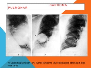 S ARCOMA 
PULMONAR 
1: Sarcoma pulmonar 2A: Tumor fantasma 2B: Radiografía obtenida 5 días 
más tarde 
 