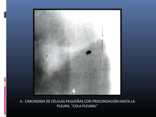 4.- CARCINOMA DE CÉLULAS PEQUEÑAS CON PROLONGACIÓN HASTA LA
PLEURA, “COLA PLEURAL”
 
