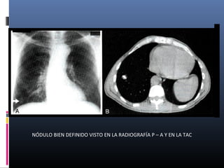 NÓDULO BIEN DEFINIDO VISTO EN LA RADIOGRAFÍA P – A Y EN LA TAC
 