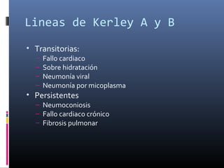 Lineas de Kerley A y B
• Transitorias:
– Fallo cardiaco
– Sobre hidratación
– Neumonía viral
– Neumonía por micoplasma
• Persistentes
– Neumoconiosis
– Fallo cardiaco crónico
– Fibrosis pulmonar
 