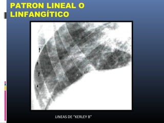 PATRON LINEAL O
LINFANGÍTICO
LINEAS DE “KERLEY B”
 