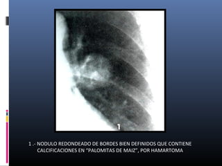 1 .- NODULO REDONDEADO DE BORDES BIEN DEFINIDOS QUE CONTIENE
CALCIFICACIONES EN “PALOMITAS DE MAIZ”, POR HAMARTOMA
 