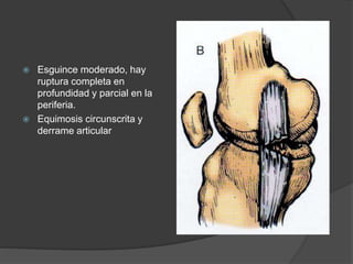  Esguince moderado, hay
ruptura completa en
profundidad y parcial en la
periferia.
 Equimosis circunscrita y
derrame articular
 