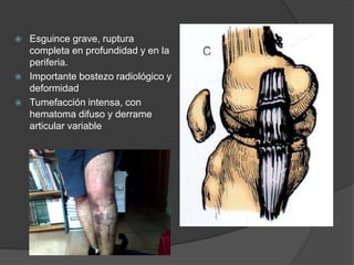  Esguince grave, ruptura
completa en profundidad y en la
periferia.
 Importante bostezo radiológico y
deformidad
 Tumefacción intensa, con
hematoma difuso y derrame
articular variable
 