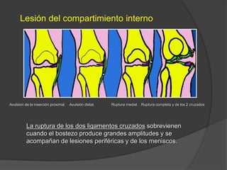 Lesión del compartimiento interno
Avulsion de la inserción proximal. Avulsión distal. Ruptura medial. Ruptura completa y de los 2 cruzados
La ruptura de los dos ligamentos cruzados sobrevienen
cuando el bostezo produce grandes amplitudes y se
acompañan de lesiones periféricas y de los meniscos.
 