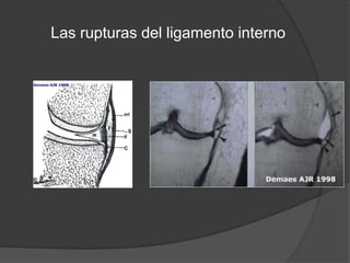 Las rupturas del ligamento interno
 