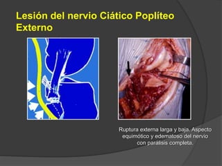 Lesión del nervio Ciático Poplíteo
Externo
Ruptura externa larga y baja. Aspecto
equimótico y edematoso del nervio
con parálisis completa.
 