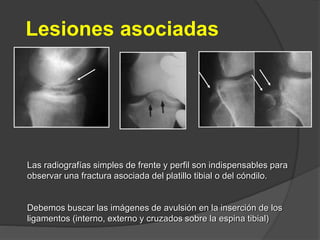 Lesiones asociadas
Las radiografías simples de frente y perfil son indispensables para
observar una fractura asociada del platillo tibial o del cóndilo.
Debemos buscar las imágenes de avulsión en la inserción de los
ligamentos (interno, externo y cruzados sobre la espina tibial)
 