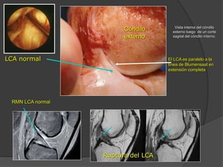 Ruptura del LCA
LCA normal
Vista interna del cóndilo
externo luego de un corte
sagital del cóndilo interno.
Cóndilo
externo
RMN LCA normal
El LCA es paralelo a la
línea de Blumensaat en
extensión completa
 