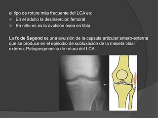 el tipo de rotura más frecuente del LCA es:
 En el adulto la desinserción femoral
 En niño es es la avulsión ósea en tibia
La fx de Segond es una avulsión de la capsula articular antero-externa
que se produce en el episodio de subluxación de la meseta tibial
externa. Patognogmonica de rotura del LCA
 