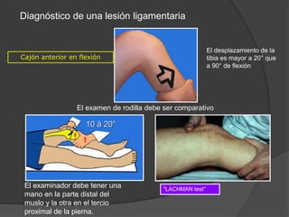 Diagnóstico de una lesión ligamentaria
"LACHMAN test"
Cajón anterior en flexión
10 à 20°
El examen de rodilla debe ser comparativo
El desplazamiento de la
tibia es mayor a 20° que
a 90° de flexión
.
El examinador debe tener una
mano en la parte distal del
muslo y la otra en el tercio
proximal de la pierna.
 