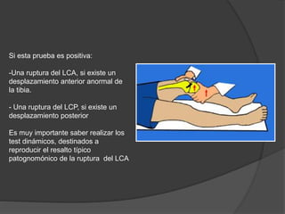Si esta prueba es positiva:
-Una ruptura del LCA, si existe un
desplazamiento anterior anormal de
la tibia.
- Una ruptura del LCP, si existe un
desplazamiento posterior
Es muy importante saber realizar los
test dinámicos, destinados a
reproducir el resalto típico
patognomónico de la ruptura del LCA
 