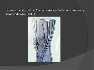 Reconstrucción del LCA, con la asociación del recto interno y
semi tendinoso (DIDT)
 