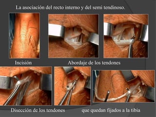 La asociación del recto interno y del semi tendinoso.
Incisión Abordaje de los tendones
Disección de los tendones que quedan fijados a la tibia
 