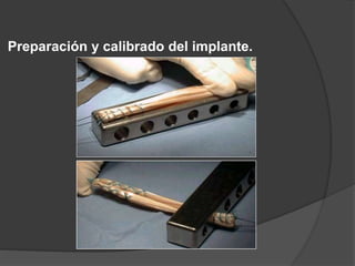Preparación y calibrado del implante.
 