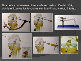 Una de las numerosas técnicas de reconstrucción del LCA,
donde utilizamos los tendones semi-tendinoso y recto interno.
 