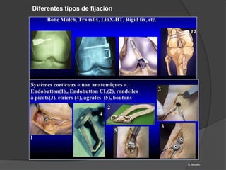 Diferentes tipos de fijación
B. Moyen
 