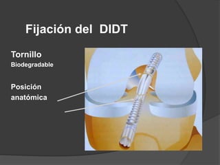 Fijación del DIDT
Tornillo
Biodegradable
Posición
anatómica
 