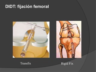 DIDT: fijación femoral
Transfix Rigid Fix
 