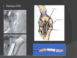  Técnica HTH
 
