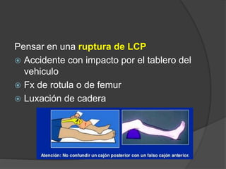 Pensar en una ruptura de LCP
 Accidente con impacto por el tablero del
vehiculo
 Fx de rotula o de femur
 Luxación de cadera
 