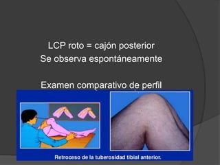 LCP roto = cajón posterior
Se observa espontáneamente
Examen comparativo de perfil
 