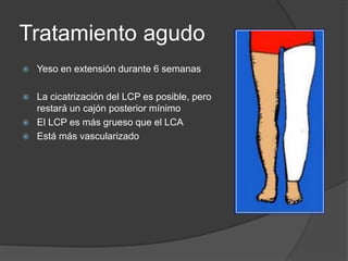 Tratamiento agudo
 Yeso en extensión durante 6 semanas
 La cicatrización del LCP es posible, pero
restará un cajón posterior mínimo
 El LCP es más grueso que el LCA
 Está más vascularizado
 