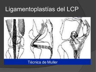 Ligamentoplastías del LCP
 