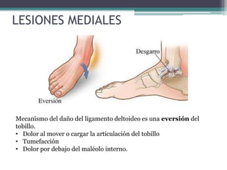 LESIONES MEDIALES
Mecanismo del daño del ligamento deltoideo es una eversión del
tobillo.
• Dolor al mover o cargar la articulación del tobillo
• Tumefacción
• Dolor por debajo del maléolo interno.
 