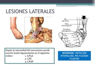 LESIONES LATERALES
Según la intensidad del mecanismo puede
ocurrir lesión ligamentaria en el siguiente
orden: 1. LPAA
2. LPC
3. LPAP
INVERSIÓN +ROTACIÓN
INTERNA DEL PIE+FLEXIÓN
PLANTAR
 