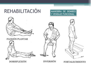 REHABILITACIÓN
FLEXIÓN PLANTAR
DORSIFLEXIÓN INVERSIÓN FORTALECIMIENTO
MANIOBRA DE BOMBEO
Y VENDAJE FUNCIONAL
 