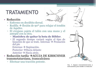 TRATAMIENTO
• Reducción
▫ Enfermo en decúbito dorsal.
▫ Rodilla  flexión de 90º para relajar el tendón
de Aquiles.
▫ El cirujano sujeta el talón con una mano y el
antepié con la otra.
 Maniobra de quitar la bota de Böhler.
 El segundo tiempo variará según el tipo de
luxación de que se trate. Internas  Pronación
del pie
Externas  Supinación.
Posterior Hacia delante
Anterior  Hacia atrás.
• Reducción tardía AGUJA DE KIRSCHNER
transmetatarsiana, transcalcánea
▫ Efectuar una tracción potente.
 