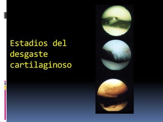 Estadios del
desgaste
cartilaginoso
 