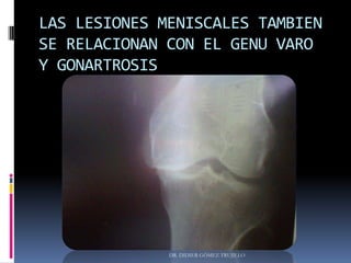 LAS LESIONES MENISCALES TAMBIEN
SE RELACIONAN CON EL GENU VARO
Y GONARTROSIS
DR. DIDIER GÓMEZ TRUJILLO
 