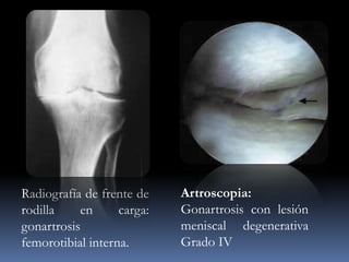 Radiografía de frente de
rodilla en carga:
gonartrosis
femorotibial interna.
Artroscopia:
Gonartrosis con lesión
meniscal degenerativa
Grado IV
 