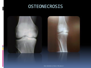 OSTEONECROSIS
DR. DIDIER GÓMEZ TRUJILLO
 