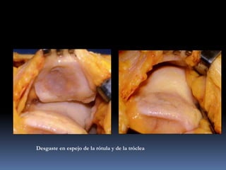 Desgaste en espejo de la rótula y de la tróclea
Artrosis fémoro-patelar
 