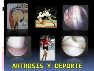 ARTROSIS Y DEPORTE
 