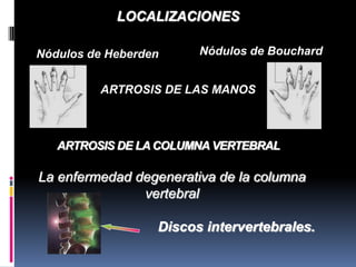 ARTROSIS DE LAS MANOS
Nódulos de BouchardNódulos de Heberden
ARTROSIS DE LA COLUMNA VERTEBRAL
La enfermedad degenerativa de la columna
vertebral
Discos intervertebrales.
LOCALIZACIONES
 