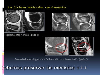 Las lesiones meniscales son frecuentes
Hiperseñal intra meniscal (grado 2)
Anomalía de morfología en la señal lineal abierta en la articulación (grado 3)
Debemos preservar los meniscos +++
 
