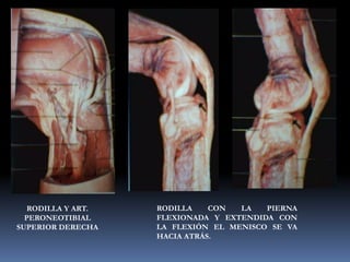 RODILLA Y ART.
PERONEOTIBIAL
SUPERIOR DERECHA
RODILLA CON LA PIERNA
FLEXIONADA Y EXTENDIDA CON
LA FLEXIÓN EL MENISCO SE VA
HACIA ATRÁS.
 