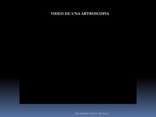 DR. DIDIER GÓMEZ TRUJILLO
VIDEO DE UNA ARTROSCOPIA
 